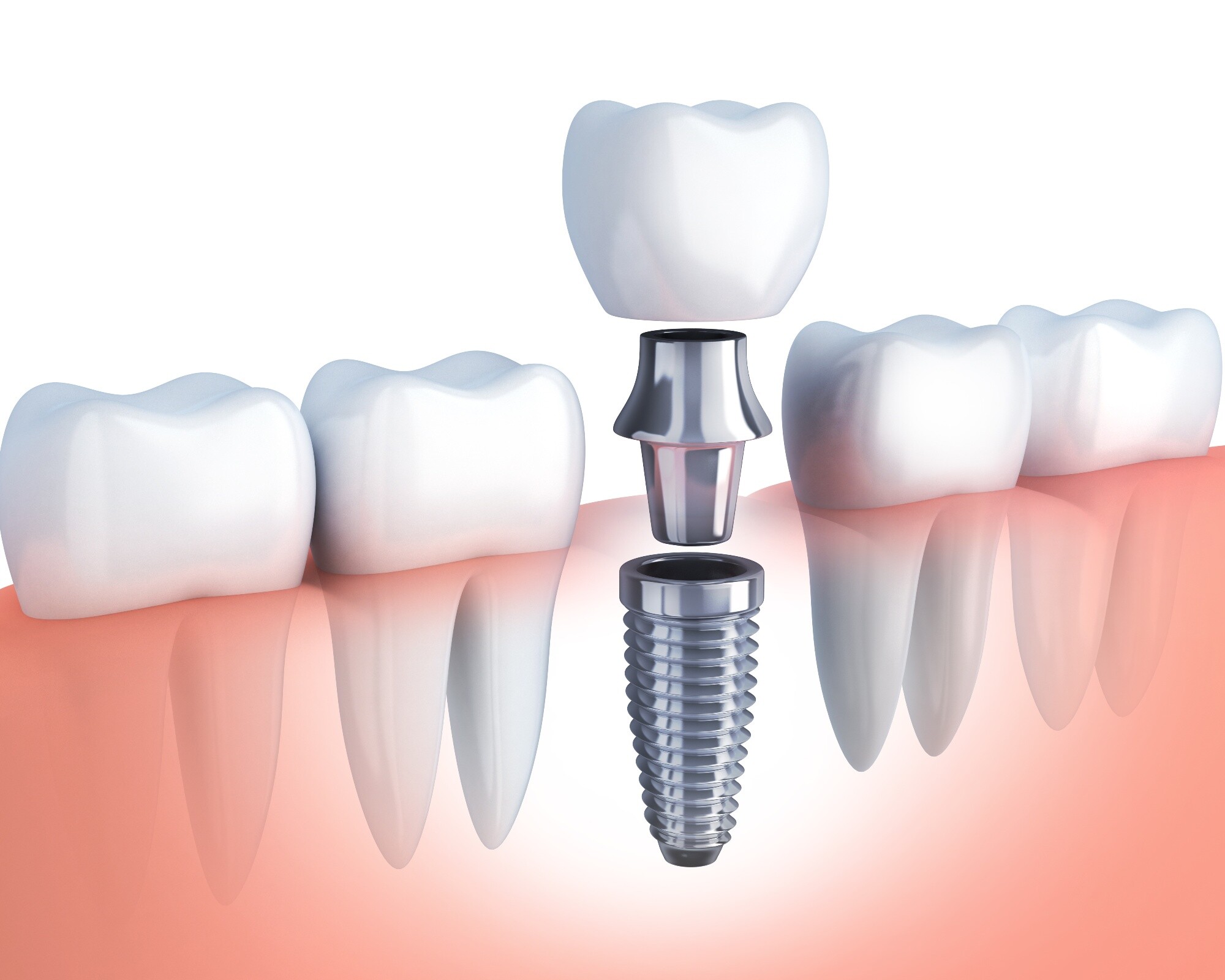 impianti dentali studio dentistico tg dental roma dentista finocchio borghesiana implantologia