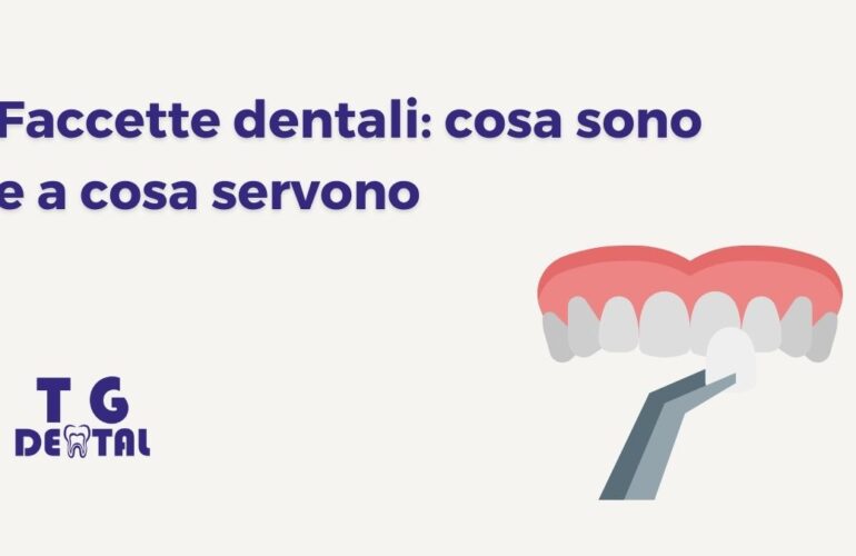 Illustrazione dell’applicazione di una faccetta dentale su un dente, con titolo “Faccette dentali: cosa sono e a cosa servono” – Studio TG Dental a Borgata Finocchio