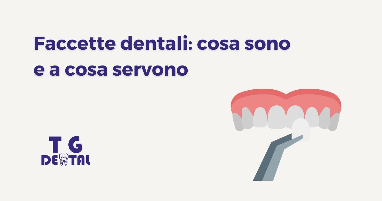 Illustrazione dell’applicazione di una faccetta dentale su un dente, con titolo “Faccette dentali: cosa sono e a cosa servono” – Studio TG Dental a Borgata Finocchio